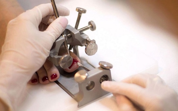 Na zdjęciu widać proces korekty wrastających paznokci. Przed zabiegiem paznokcie były bolesne i wrastały w skórę, co powodowało dyskomfort. Po zabiegu paznokcie są prawidłowo ukształtowane i nie wrastają już w skórę, co przynosi ulgę i poprawia komfort chodzenia.