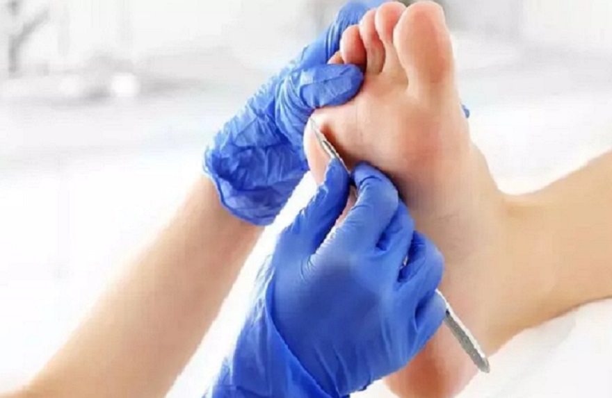 Usuwanie modzeli  – Zbliżenie na stopę w trakcie usuwania przez specjalistke modzela specjalistycznym nartzędziem na podeszwie stopy. Specjalista jest w niebeskich jednorazowych rękawiczkach