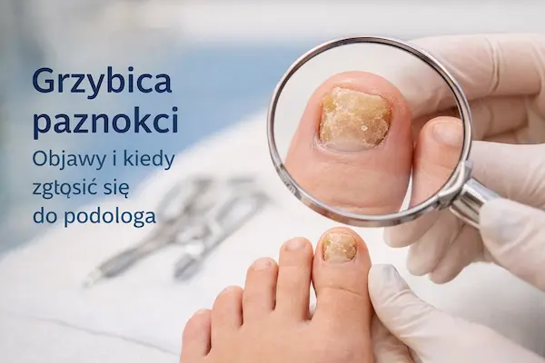 Zdjęcie przedstawia stopę pacjenta z widocznymi zmianami grzybiczymi na paznokciach. Podolog w rękawiczkach ochronnych ogląda paznokieć palucha przez lupę, oceniając jego stan. W tle widoczne są narzędzia podologiczne w gabinecie, co podkreśla profesjonalną diagnostykę grzybicy paznokci.