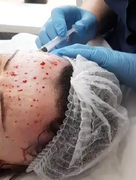 Czy wiesz skąd wzięła się nazwa "Wampirzy Lifting"?