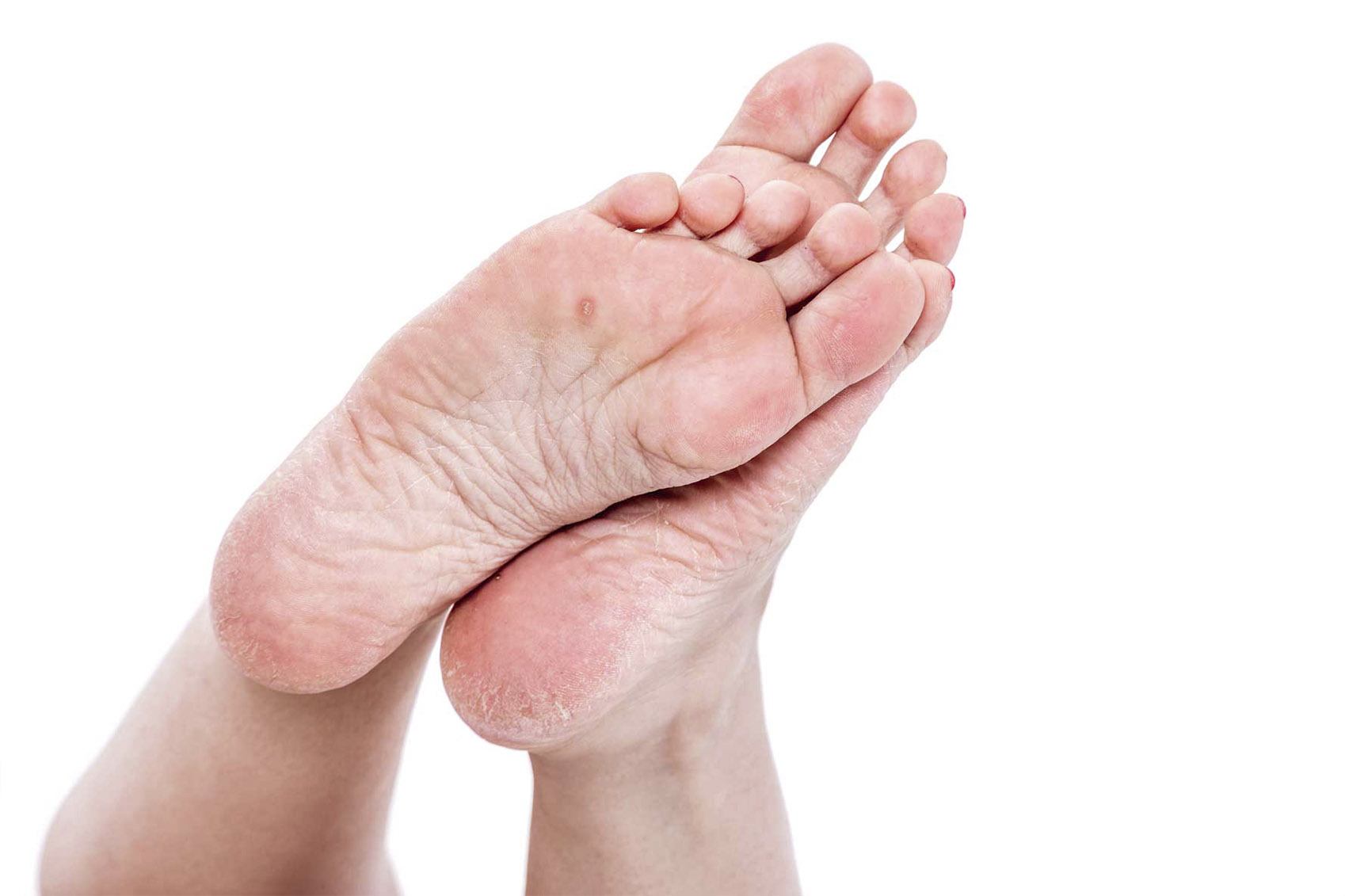 Co to jest odcisk i modzel? Jak je odróżnić i leczyć?