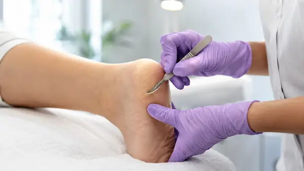 Pedicure podologiczny Rzeszów – specjalistyczne opracowanie pękających pięt podczas zabiegu podologicznego. Podolog usuwa zrogowaciały naskórek i wygładza głębokie pęknięcia pięt w sterylnych warunkach, przywracając skórze zdrowy wygląd i komfort chodzenia