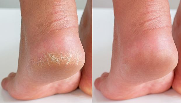 Opracowanie pękających – Zbliżenie na pięty przed i po zabiegu pielęgnacyjnym. Po lewej stronie widać piętę z pękającą i suchą skórą, a po prawej stronie ta sama pięta po zabiegu, wyraźnie gładsza i nawilżona.
