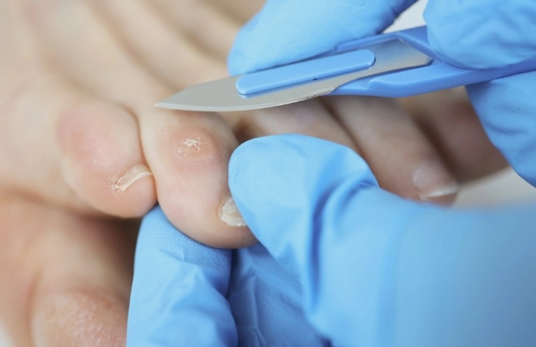 Jakie metody radzenia sobie z odciskami zna podologia?