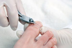 Jak postępować z wrastającymi paznokciami u stóp? Metody korekcji i leczenie