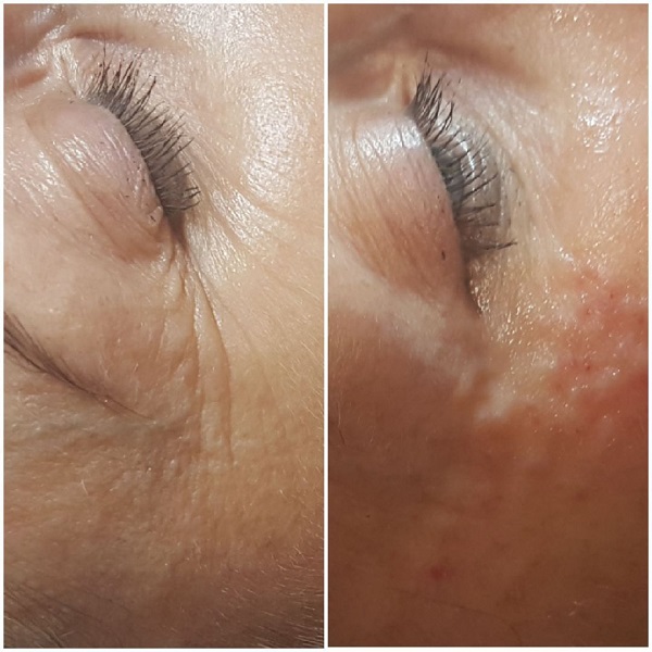 Mezoterapia igłowa -  Na zdjęciu widzimy efekt przed i po zabiegu mezoterapii igłowej wokół oczu. Po lewej stronie widoczne są zmarszczki oraz drobne linie, typowe dla skóry dojrzałej. Po prawej stronie, po zabiegu, skóra jest wyraźnie wygładzona, a zmarszczki są mniej widoczne. Mezoterapia igłowa to zabieg, który intensywnie nawilża i regeneruje skórę, redukując oznaki starzenia. Jest to doskonała opcja dla osób chcących poprawić wygląd swojej skóry bez użycia bardziej inwazyjnych metod. Tego rodzaju zabiegi są dostępne w salonach kosmetycznych w Rzeszowie, zapewniając widoczne i satysfakcjonujące efekty.