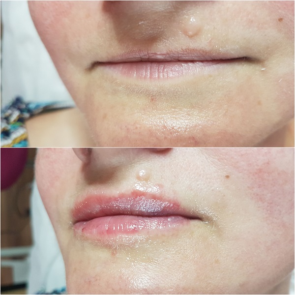 Powiększanie i modelowanie ust - Na zdjęciu widoczne są usta przed i po zabiegu powiększania. Na górnej części obrazu usta są naturalne, wąskie i bez widocznych oznak wypełnienia. Na dolnej części obrazu usta są wyraźnie pełniejsze, bardziej nawilżone i kształtne, co świadczy o wykonanym zabiegu powiększania ust. Różnica w wyglądzie ust przed i po zabiegu jest znacząca, ukazując efekty pracy specjalisty z zakresu kosmetologii estetycznej.