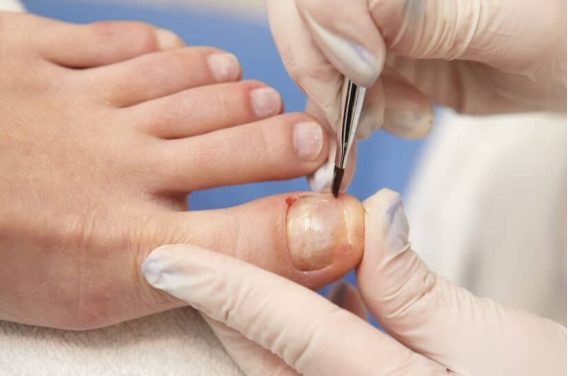 Zdjęcie przedstawia podologa wykonującego rekonstrukcję paznokcia u stopy pacjenta. Widoczna jest dłoń w rękawiczce, która za pomocą pędzelka nakłada preparat na uszkodzony paznokieć palucha. Scena ukazuje precyzyjną pracę specjalisty w trakcie zabiegu podologicznego.